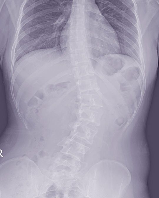 Scoliosis Treatment In Singapore Harrington Rod Surgery